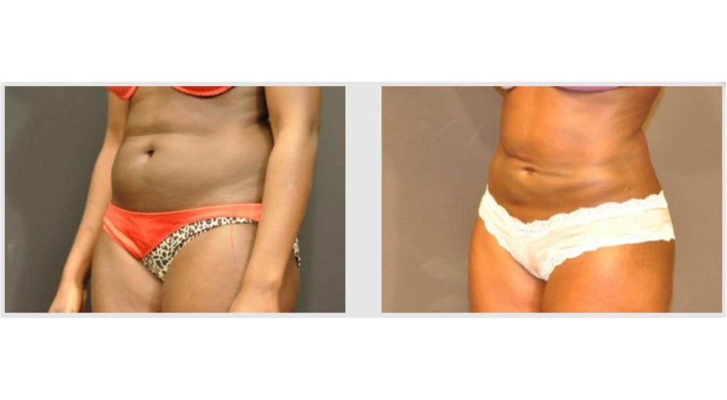 A Before and After photo of a Liposuction Plastic Surgery by Dr. Craig Jonov in Seattle and Tacoma
