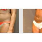 A Before and After photo of a Liposuction Plastic Surgery by Dr. Craig Jonov in Seattle and Tacoma