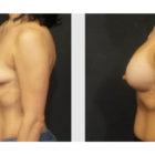 A Before and After photo of a Breast Augmentation Plastic Surgery by Dr. Craig Jonov in Seattle and Tacoma