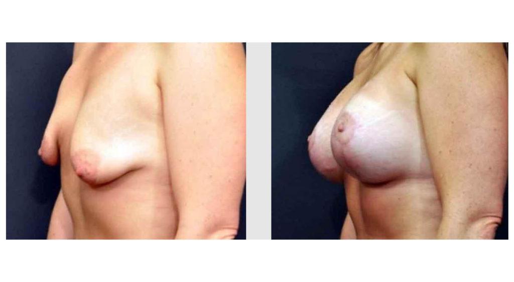 A Before and After photo of a Breast Augmentation Plastic Surgery by Dr. Craig Jonov in Seattle and Tacoma