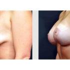 A Before and After photo of a Breast Augmentation Plastic Surgery by Dr. Craig Jonov in Seattle and Tacoma