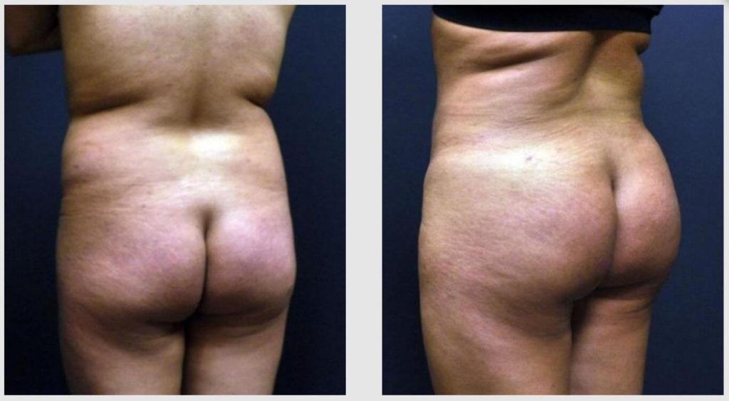 A Before and After photo of a Liposuction Plastic Surgery by Dr. Craig Jonov in Seattle and Tacoma