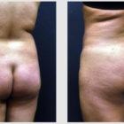 A Before and After photo of a Liposuction Plastic Surgery by Dr. Craig Jonov in Seattle and Tacoma