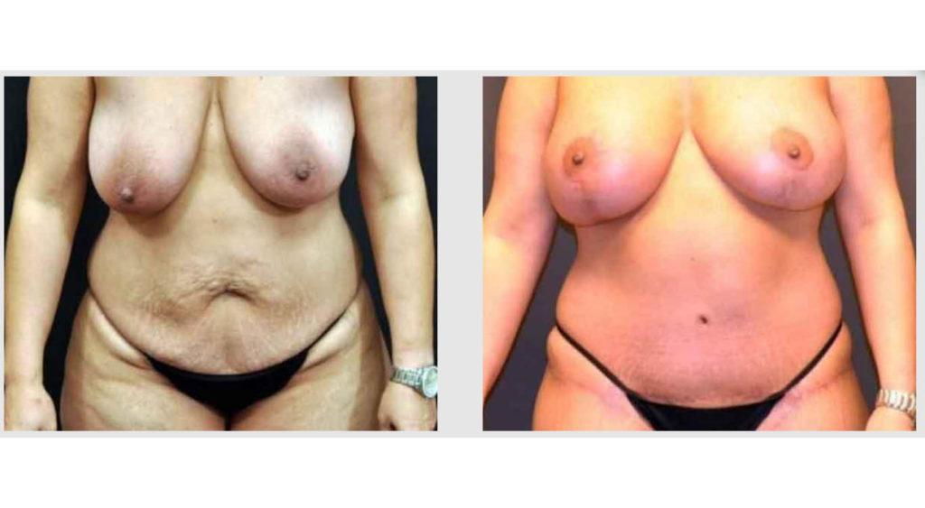 A Before and After photo of a Tummy Tuck Plastic Surgery by Dr. Craig Jonov in Seattle and Tacoma