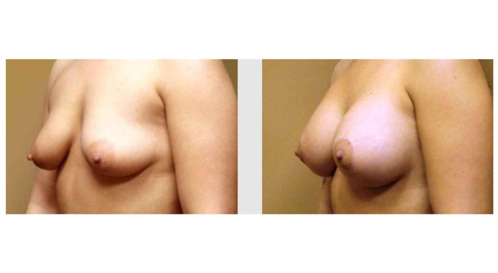 A Before and After photo of a Breast Augmentation Plastic Surgery by Dr. Craig Jonov in Seattle and Tacoma