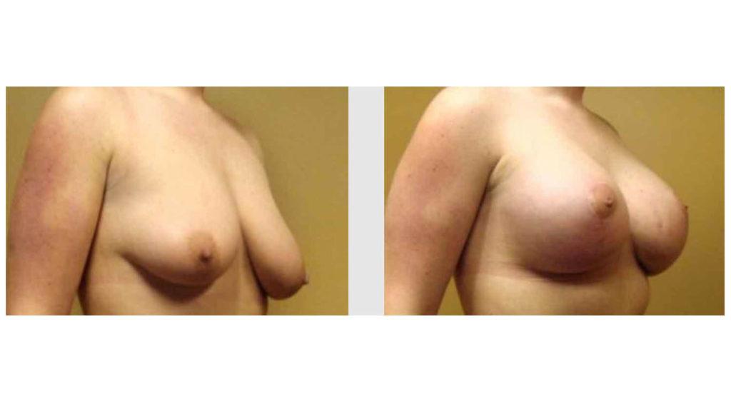 A Before and After photo of a Breast Augmentation Plastic Surgery by Dr. Craig Jonov in Seattle and Tacoma