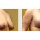 A Before and After photo of a Breast Augmentation Plastic Surgery by Dr. Craig Jonov in Seattle and Tacoma