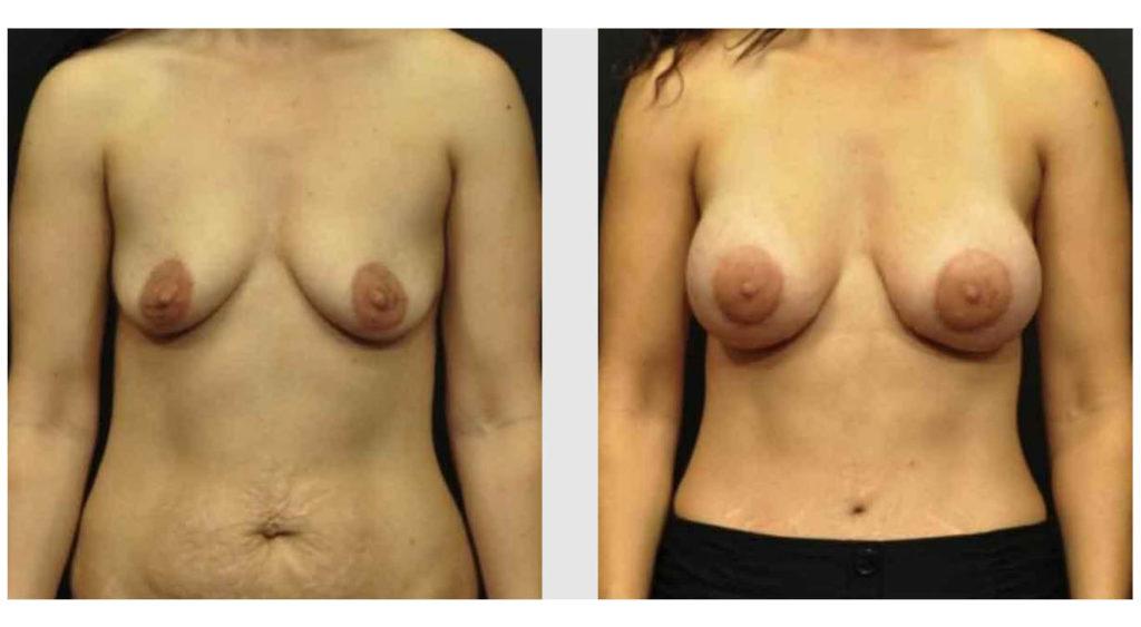 A Before and After photo of a Breast Augmentation Plastic Surgery by Dr. Craig Jonov in Seattle and Tacoma