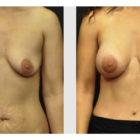 A Before and After photo of a Breast Augmentation Plastic Surgery by Dr. Craig Jonov in Seattle and Tacoma