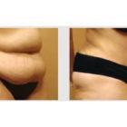 A Before and After photo of an Extended Tummy Tuck Plastic Surgery by Dr. Craig Jonov in Seattle and Tacoma