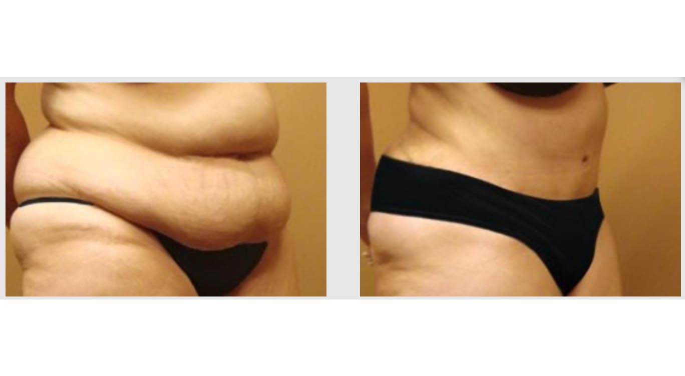 A Before and After photo of an Extended Tummy Tuck Plastic Surgery by Dr. Craig Jonov in Seattle and Tacoma