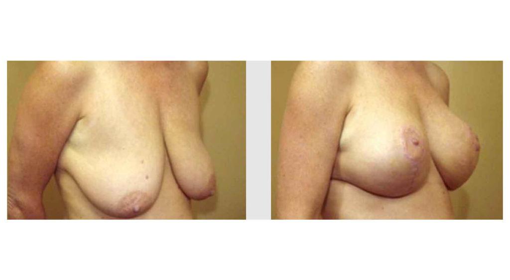 A Before and After photo of a Breast Augmentation Plastic Surgery by Dr. Craig Jonov in Seattle and Tacoma