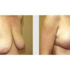 A Before and After photo of a Breast Augmentation Plastic Surgery by Dr. Craig Jonov in Seattle and Tacoma