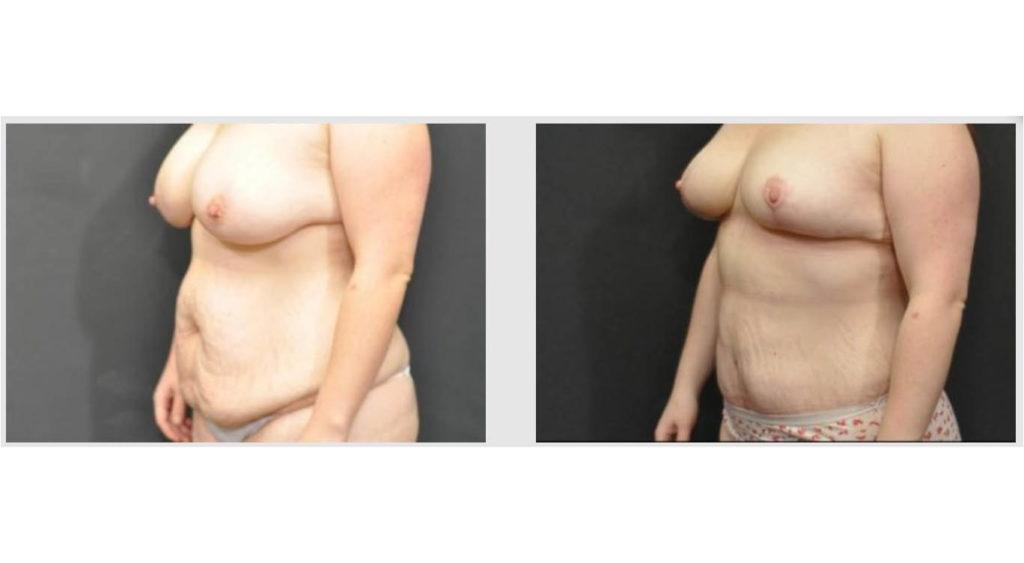 A Before and After photo of a Tummy Tuck Plastic Surgery by Dr. Craig Jonov in Seattle and Tacoma