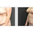 A Before and After photo of a Tummy Tuck Plastic Surgery by Dr. Craig Jonov in Seattle and Tacoma