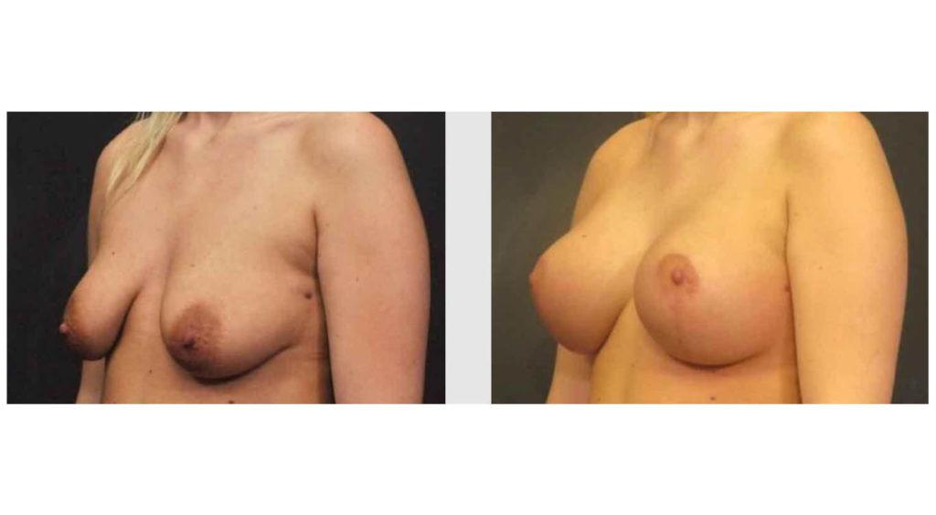 A Before and After photo of a Breast Augmentation Plastic Surgery by Dr. Craig Jonov in Seattle and Tacoma