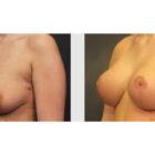 A Before and After photo of a Breast Augmentation Plastic Surgery by Dr. Craig Jonov in Seattle and Tacoma