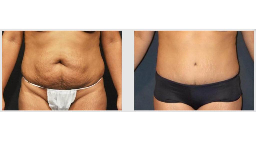 A Before and After photo of a Tummy Tuck Plastic Surgery by Dr. Craig Jonov in Seattle and Tacoma