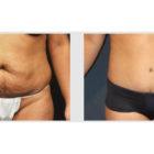 A Before and After photo of a Tummy Tuck Plastic Surgery by Dr. Craig Jonov in Seattle and Tacoma