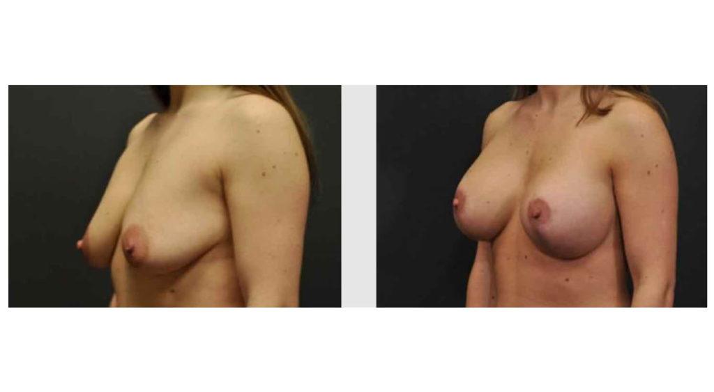 A Before and After photo of a Breast Augmentation Plastic Surgery by Dr. Craig Jonov in Seattle and Tacoma