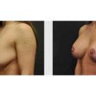 A Before and After photo of a Breast Augmentation Plastic Surgery by Dr. Craig Jonov in Seattle and Tacoma