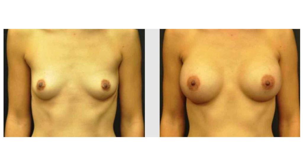 A Before and After photo of a Breast Augmentation Plastic Surgery by Dr. Craig Jonov in Seattle and Tacoma