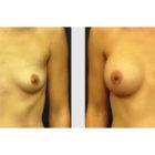 A Before and After photo of a Breast Augmentation Plastic Surgery by Dr. Craig Jonov in Seattle and Tacoma