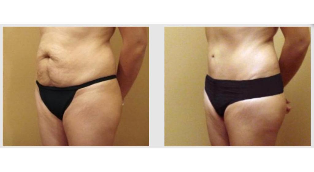 A Before and After photo of a Tummy Tuck Plastic Surgery by Dr. Craig Jonov in Seattle and Tacoma