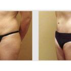 A Before and After photo of a Tummy Tuck Plastic Surgery by Dr. Craig Jonov in Seattle and Tacoma