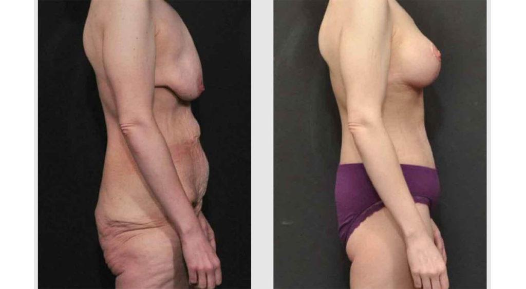 A Before and After photo of a Tummy Tuck Plastic Surgery by Dr. Craig Jonov in Seattle and Tacoma