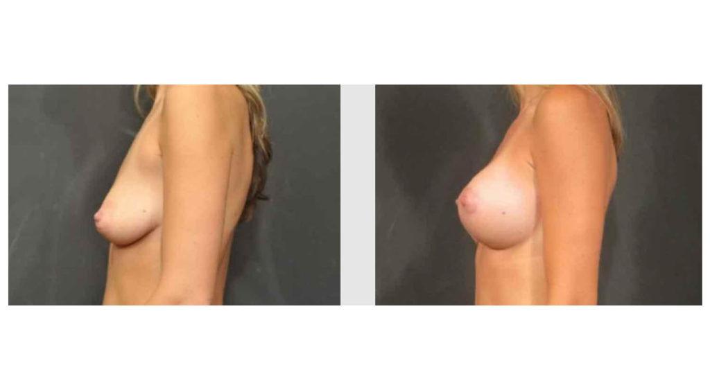 A Before and After photo of a Breast Augmentation Plastic Surgery by Dr. Craig Jonov in Seattle and Tacoma