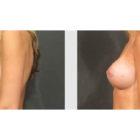 A Before and After photo of a Breast Augmentation Plastic Surgery by Dr. Craig Jonov in Seattle and Tacoma