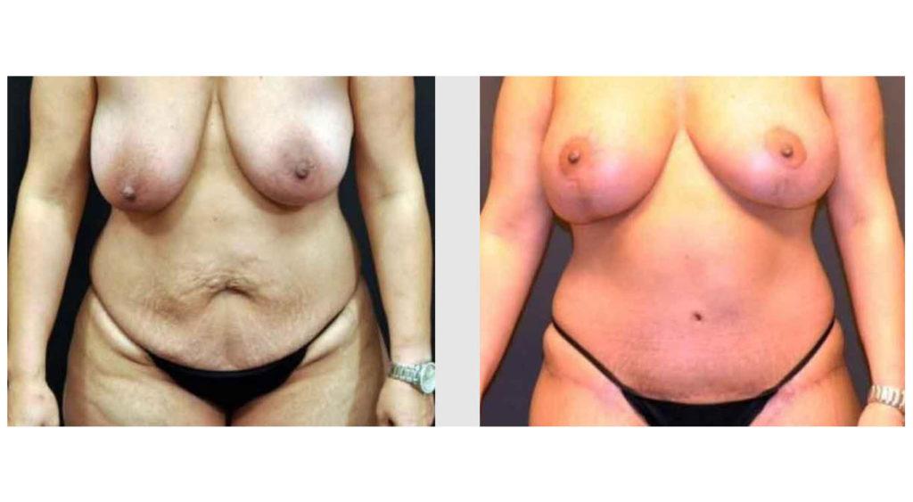 A Before and After photo of a Breast Augmentation Plastic Surgery by Dr. Craig Jonov in Seattle and Tacoma