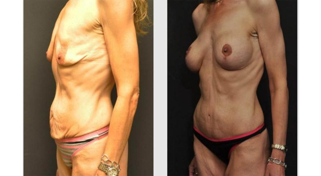 A Before and After photo of a Tummy Tuck Plastic Surgery by Dr. Craig Jonov in Seattle and Tacoma