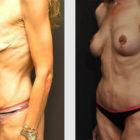 A Before and After photo of a Tummy Tuck Plastic Surgery by Dr. Craig Jonov in Seattle and Tacoma