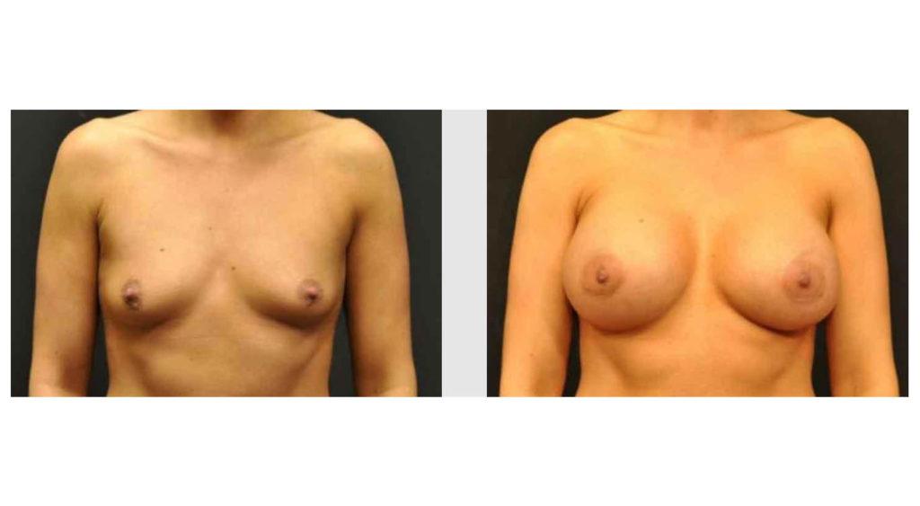 A Before and After photo of a Breast Augmentation Plastic Surgery by Dr. Craig Jonov in Seattle and Tacoma