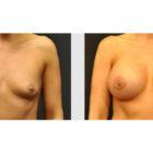 A Before and After photo of a Breast Augmentation Plastic Surgery by Dr. Craig Jonov in Seattle and Tacoma