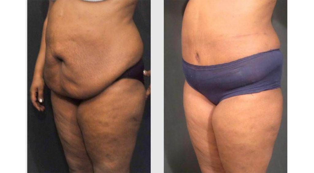 A Before and After photo of a Tummy Tuck Plastic Surgery by Dr. Craig Jonov in Seattle and Tacoma