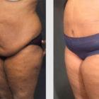 A Before and After photo of a Tummy Tuck Plastic Surgery by Dr. Craig Jonov in Seattle and Tacoma