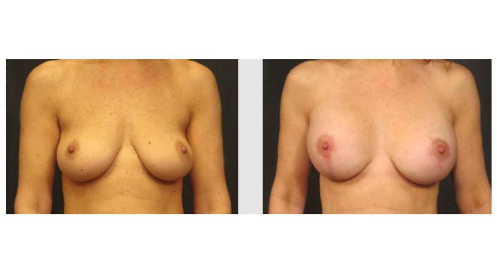 A Before and After photo of a Breast Augmentation Plastic Surgery by Dr. Craig Jonov in Seattle and Tacoma