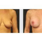 A Before and After photo of a Breast Augmentation Plastic Surgery by Dr. Craig Jonov in Seattle and Tacoma