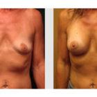 A Before and After photo of a Breast Augmentation Plastic Surgery by Dr. Craig Jonov in Seattle and Tacoma