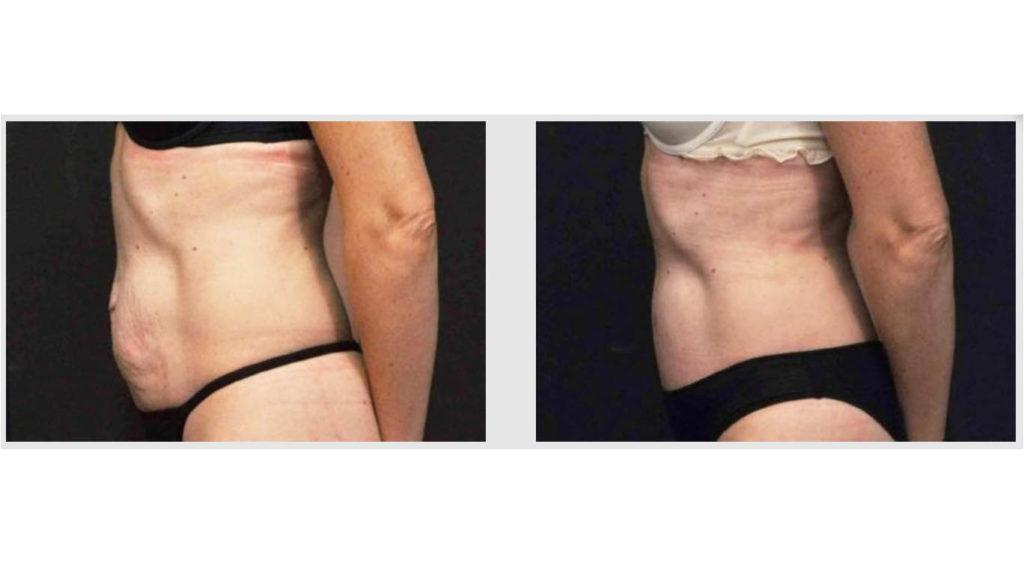 A Before and After photo of a Tummy Tuck Plastic Surgery by Dr. Craig Jonov in Seattle and Tacoma