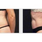 A Before and After photo of a Tummy Tuck Plastic Surgery by Dr. Craig Jonov in Seattle and Tacoma