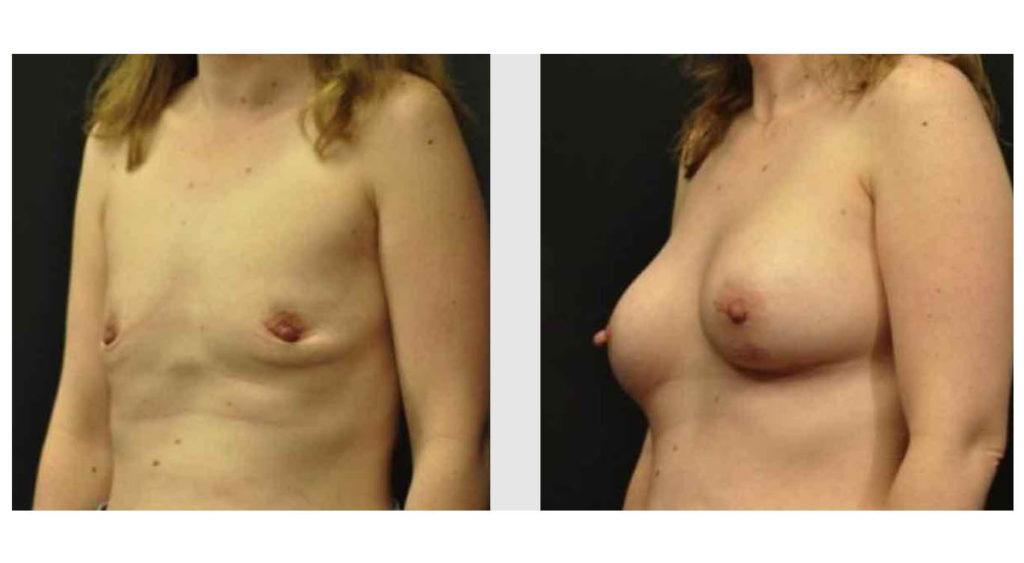 A Before and After photo of a Breast Augmentation Plastic Surgery by Dr. Craig Jonov in Seattle and Tacoma