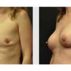 A Before and After photo of a Breast Augmentation Plastic Surgery by Dr. Craig Jonov in Seattle and Tacoma