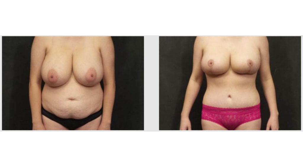 A Before and After photo of a Tummy Tuck Plastic Surgery by Dr. Craig Jonov in Seattle and Tacoma