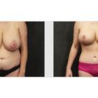 A Before and After photo of a Tummy Tuck Plastic Surgery by Dr. Craig Jonov in Seattle and Tacoma