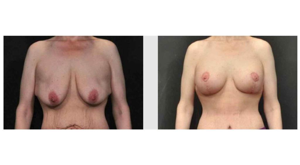 A Before and After photo of a Breast Augmentation Plastic Surgery by Dr. Craig Jonov in Seattle and Tacoma