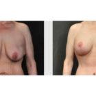 A Before and After photo of a Breast Augmentation Plastic Surgery by Dr. Craig Jonov in Seattle and Tacoma